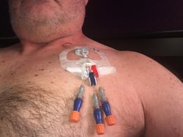 chemo infusion port in cancer patient’s clavicle makes chemo treatments much easier
