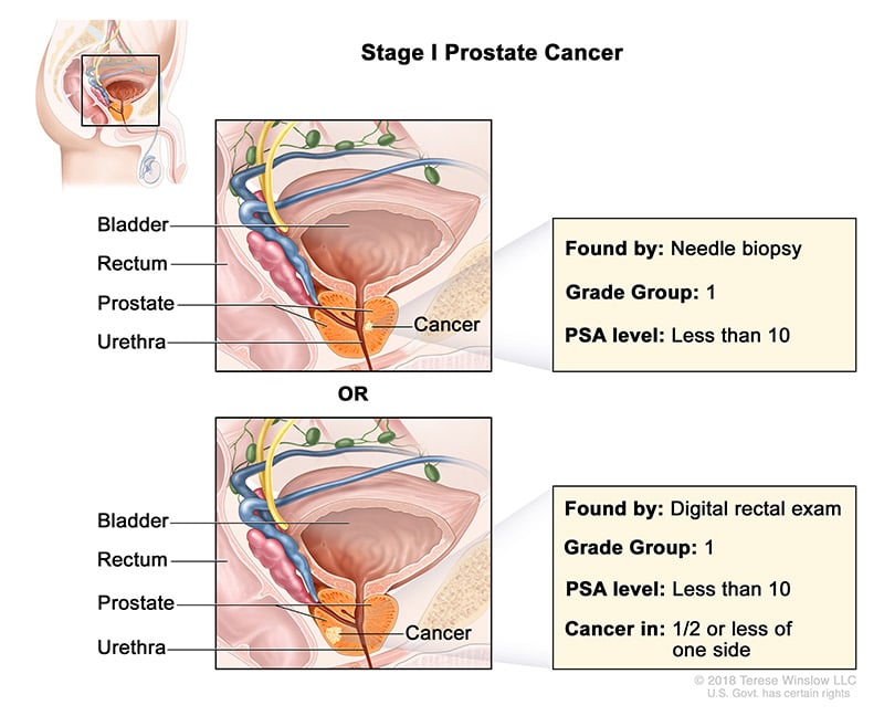 prostate-stage-1