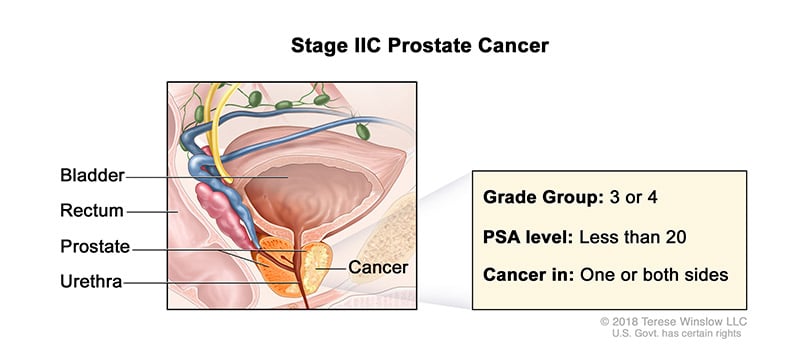 prostate-stage-2C