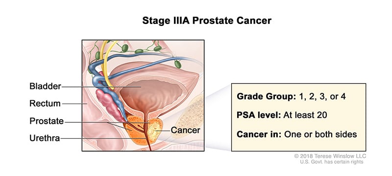 prostate-stage-3A