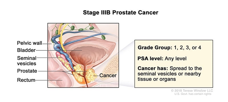 prostate-stage-3B